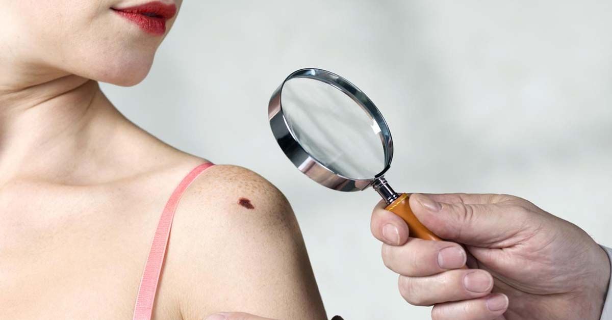 Знаки небезпеки: як розпізнати рак шкіри на ранніх стадіях
