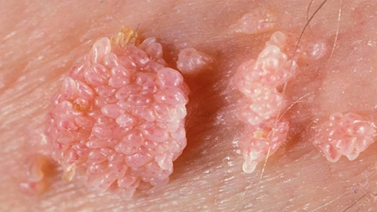 Рак вульви: які симптоми і що робити при перших ознаках? 2 Рак вульви
