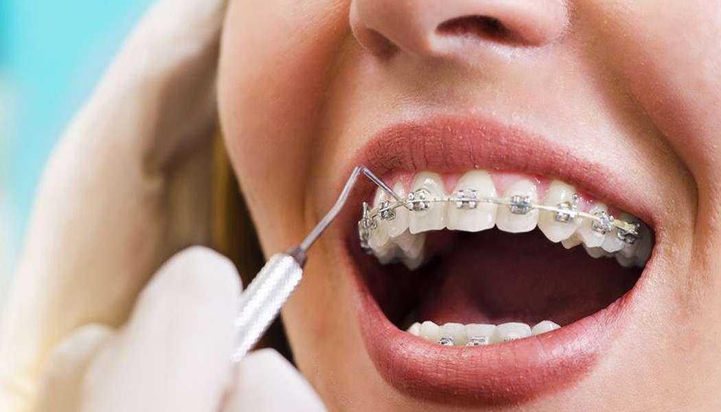 брекет-системи в OrthoSmiles
